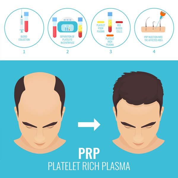 Hair Restoration In Camarillo | PRP For Hair Restoration | Regen Doctor