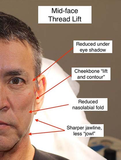 The Contour Thread Lift – A Great Face Lift Option For Men